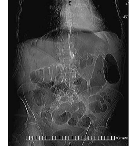 Plain abdominal x-ray shows free air under the diaphragm and massive ...