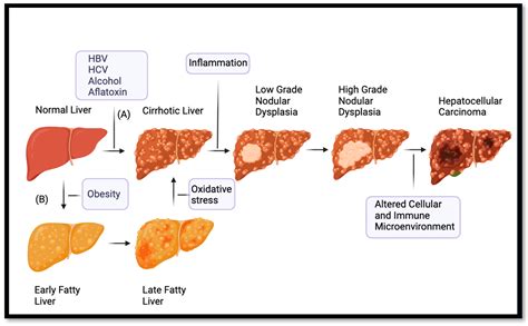 Ijms Free Full Text Hepatocellular Carcinoma Past And Present Challenges And Progress In