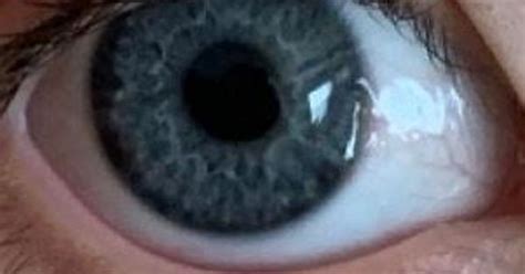 Cornea Indentations Album On Imgur