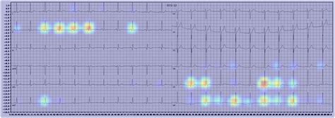 Frontiers Image Based Deep Learning In 12 Lead Ecg Diagnosis