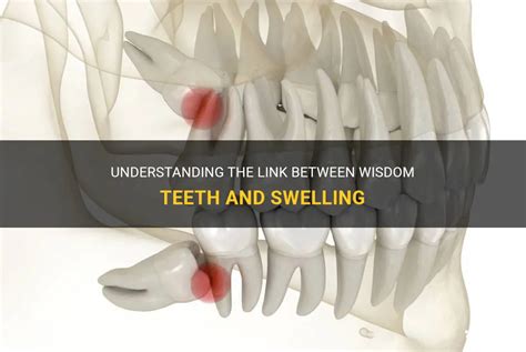 Understanding The Link Between Wisdom Teeth And Swelling | MedShun