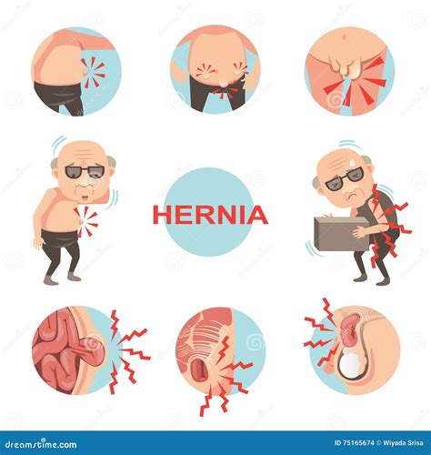 Stomach Hernia Symptoms In Men