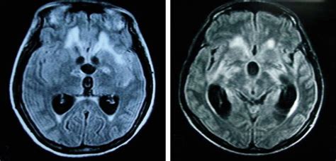 Tuberculous Meningitis Many Questions Too Few Answers The Lancet Neurology