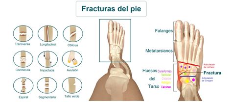 Signos De Fractura De Hueso