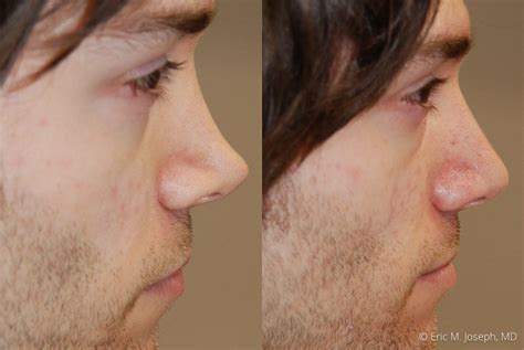 Eric M Joseph Md Non Surgical Rhinoplasty Before And After Tip