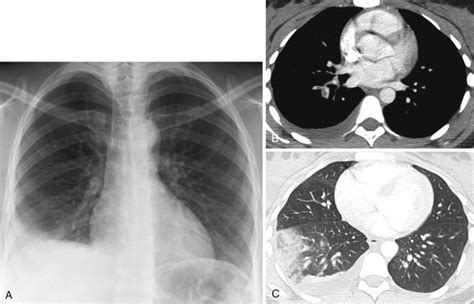 Pulmonary Arteries Radiology Key