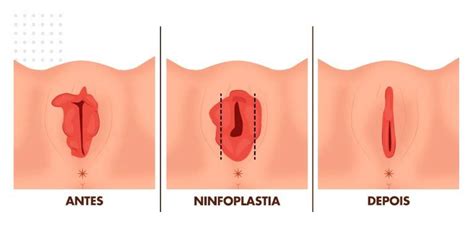 Ninfoplastia Sem Hospital Qual O Valor Em S O Paulo