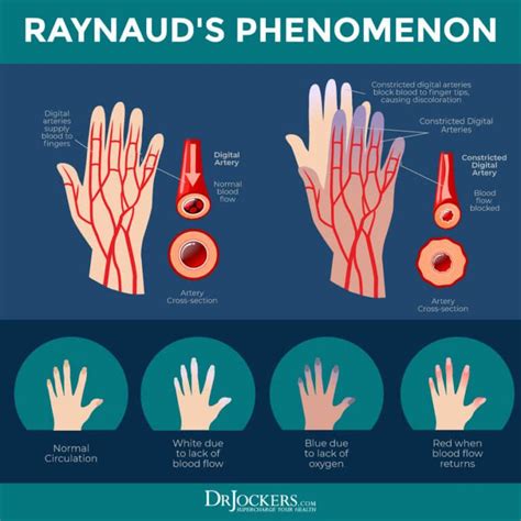 Raynaud’s Phenomenon Causes Symptoms And Support Strategies Artofit