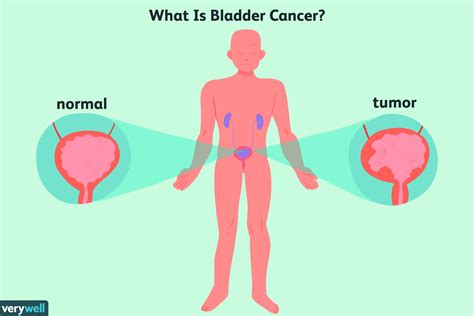 Bladder Cancer Overview And More