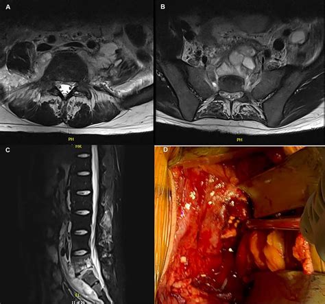 (A-C) MRI depicting the osteomyelitis, discitis and abscess involvement ...