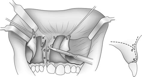 Alveolar-anterior Maxillary Cleft Repair - Atlas of the Oral and