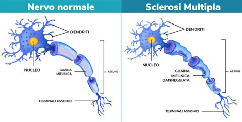 Sclerosi Multipla