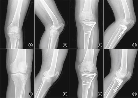 Two Cases Of Schatzker Type Ii Tibial Plateau Fracture A D Case 1