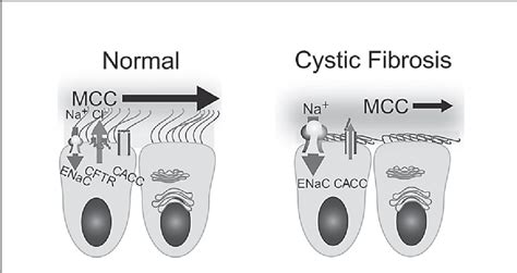 Figure 1 From Pathophysiology Of Cystic Fibrosis Semantic Scholar