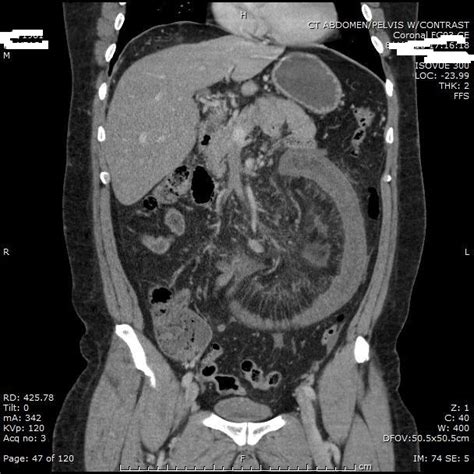 Mesenteric Vessels Mesenteric Venous Thrombosis 2984 Mvt Barreras Kino