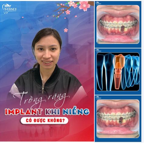 TRỒNG RĂNG IMPLANT TRONG KHI NIỀNG CÓ ĐƯỢC KHÔNG