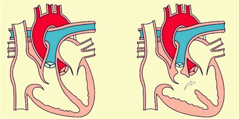 Defectos Congenitos Del Corazon