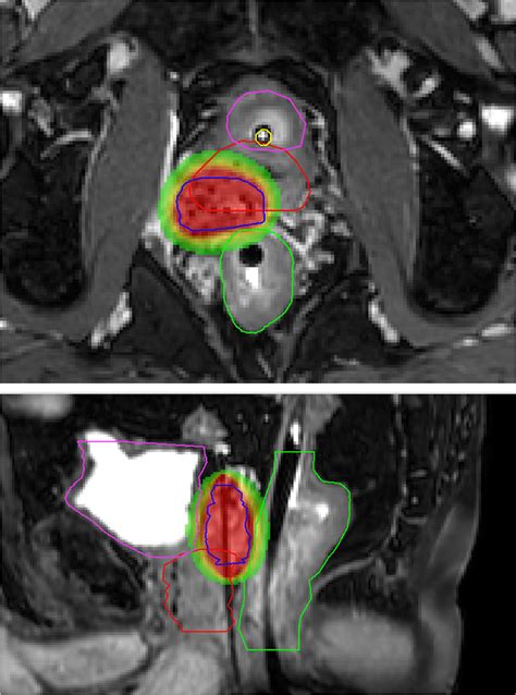 Dose Distribution First Mri Guided Focal Salvage Hdr Bt Transversal