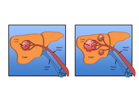 Factors Increasing Recurrence Of Hepatocellular Carcinoma Post Liver Transplant The Organ