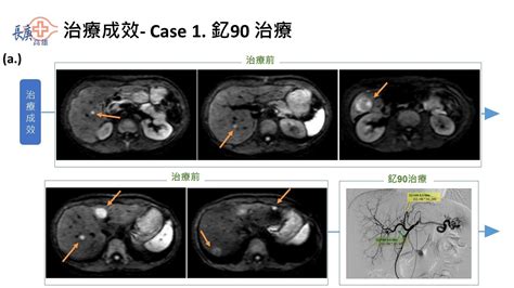 釔90經動脈治療肝癌之精準醫療時代 長庚紀念醫院