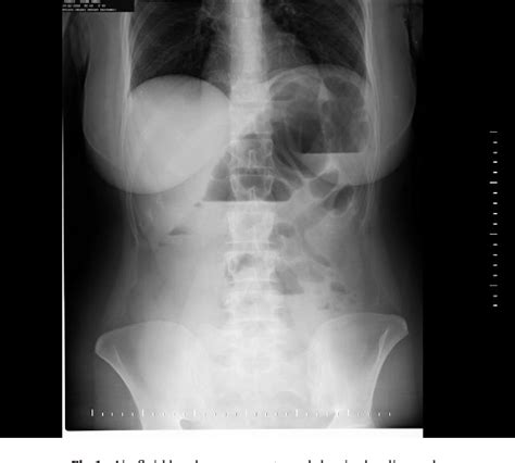 Adult Midgut Malrotation Presented With Acute Bowel Obstruction And Ischemia Semantic Scholar