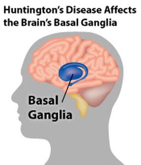 Huntington's Disease - Genetic Disorders