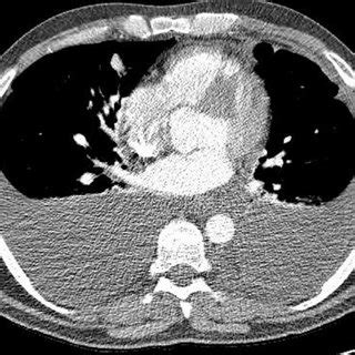 Axial CT Pulmonary Angiography Demonstrating Large Bilateral Pleural