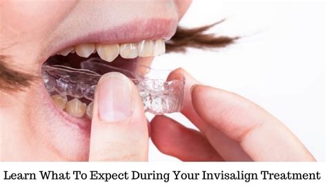 What To Expect During Your Invisalign Treatment