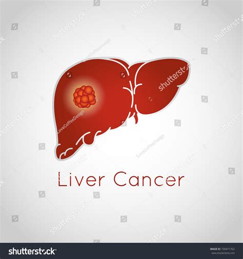 Liver Cancer Vector Logo Icon Illustration Stock Vector Royalty Free 730471762