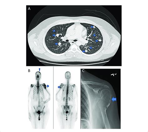 Radiologic Images Of Distant Metastasis In Papillary Thyroid