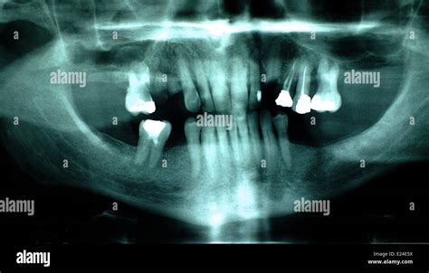 Dental X Ray Amalgam Hi Res Stock Photography And Images Alamy