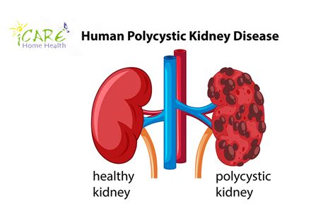 Polycystic Kidney Disease Concept Map