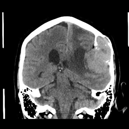 Solitary Fibrous Tumor Hemangiopericytoma Image Radiopaedia Org