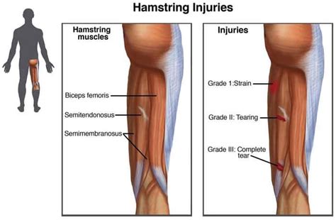 Combating Hamstring Tears - Massage in Ashburn