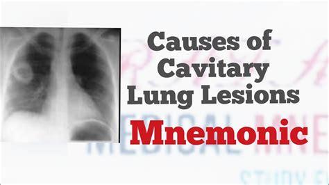 Causes of Cavitary Lung Lesions | Mnemonic "CAVITARY" for all causes of ...