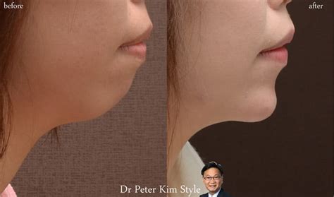 Cosmetic Injection Sydney Dr Peter Kim Surgery Skin Cancer