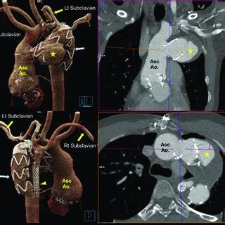 Three Dimensional Reconstruction Of Computed Tomography Angiography In