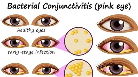 Conjunctivitis: Simple home remedies to treat the eye condition ...