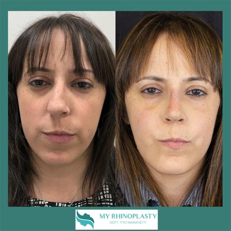 Setto Nasale Deviato Complicazioni E Soluzioni My Rhinoplasty