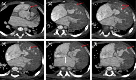 Chd Free Full Text Assessment Of Intracardiac And Extracardiac