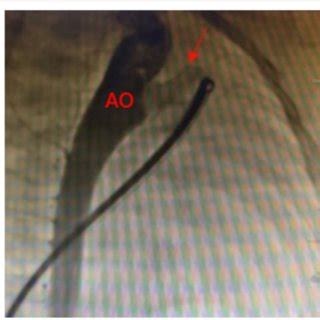 Transthoracic echocardiography results before occlusion. The white ...