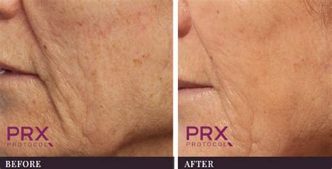 Prx Derm Chemical Peel Anti Aging Treatment Velvet Touch Rockwall