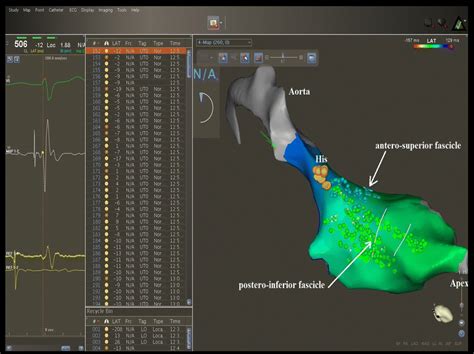 Three Dimensional Electroanatomical Mapping Of The Left Branch Of The