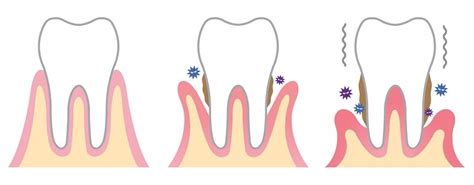 What Is Periodontitis ¿que Es Periodontitis Mi Dental