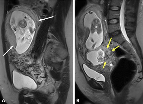 Dichorionic Diamniotic Heterotopic Twin Gestation With Cesarean Section