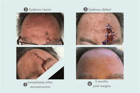 Mohs Surgery In Scottsdale Paradise Valley Skin Cancer Surgery