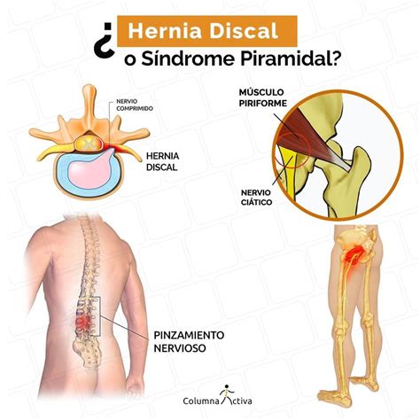 El nervio ciático es el más grande y largo de los nervios del cuerpo