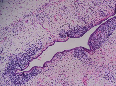 SARCOMA BOTRYOIDES (EMBRYONAL RHABDOMYOSARCOMA ) – CERVIX ...