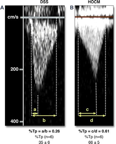 Lv Outflow Tract Area In Discrete Subaortic Stenosis And Hypertrophic