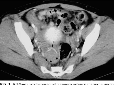 Hemorrhagic Corpus Luteum Ultrasound